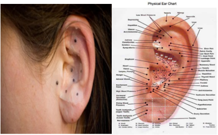 Ear seed placement photograph beside a labeled physical ear acupuncture chart